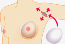 不使用凯勒漏斗